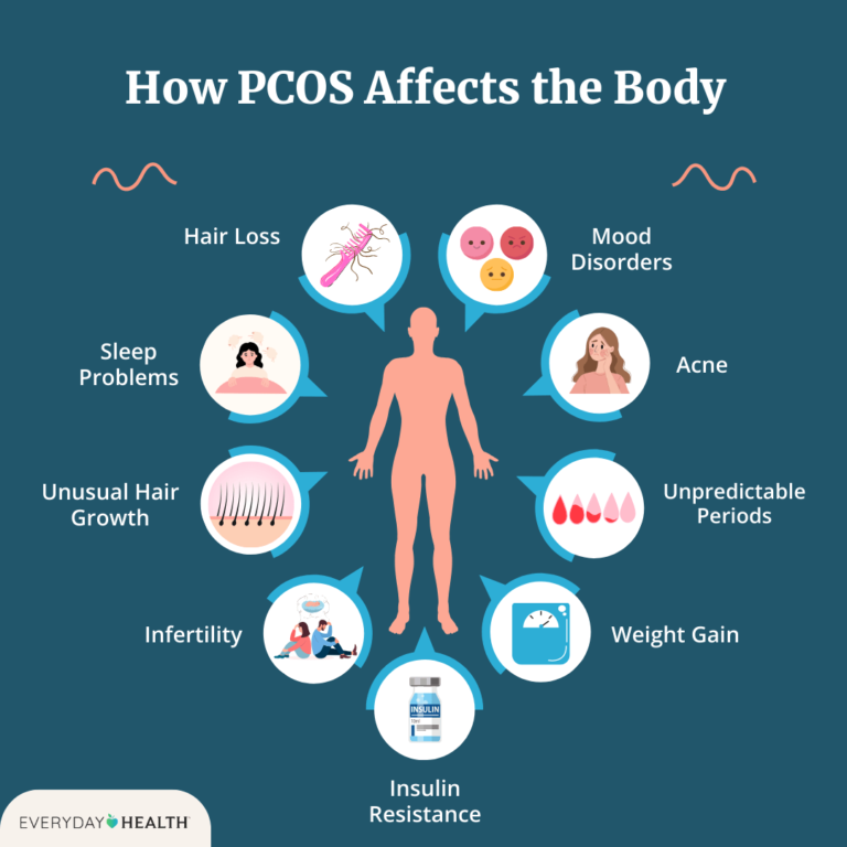 What Is Polycystic Ovary Syndrome (PCOS)? Symptoms, Causes, Diagnosis ...